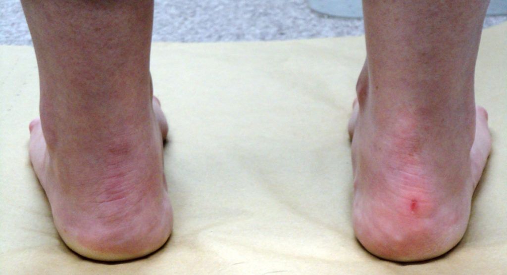 Ankle Sprain Recovery Exercises: Healing & Pathology Explained