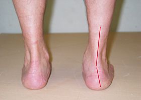 calcaneal valgus