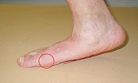 positive single-foot heel rise test