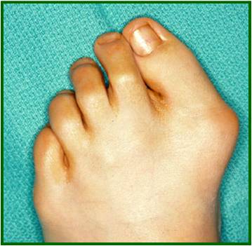 Hallux Valgus